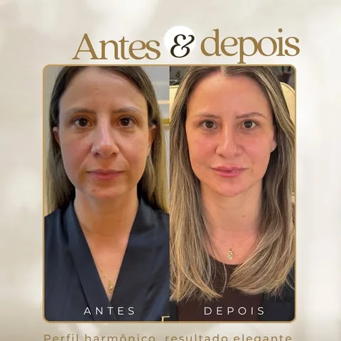 Antes e depois harmonização facial — Exclusive