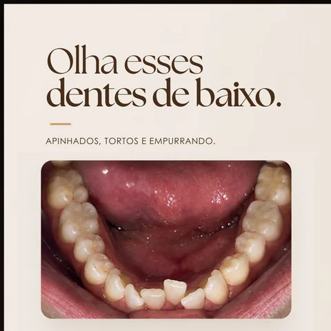 Invisalign Brasília — Exclusive Odontologia